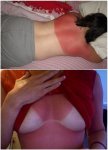 102_1649-alt-blog-sun-burn 2.jpg